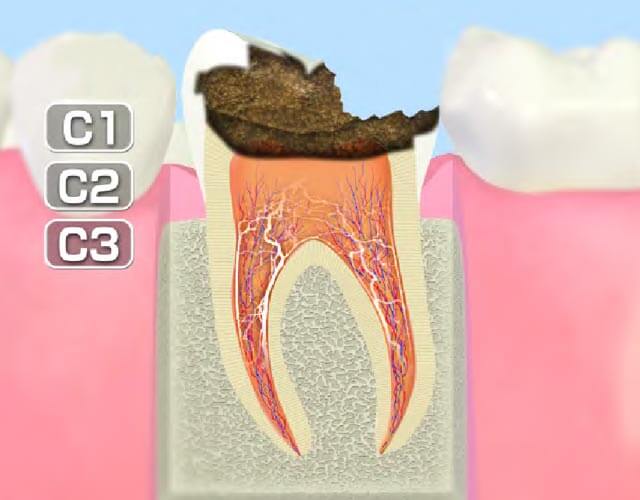 歯髄まで進行したむし歯（C3）